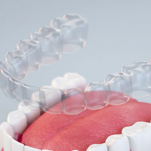 Invisalign Santa Monica