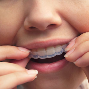 Invisalign Santa Monica